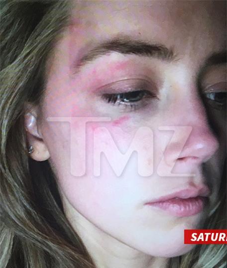 Amber Heard tung ảnh bầm mắt, tố Johnny Depp bạo hành mình - Ảnh 1.