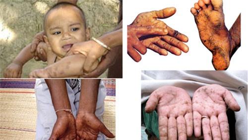 Những hình ảnh đáng sợ khi trẻ bị nhiễm độc chì - Ảnh 2.