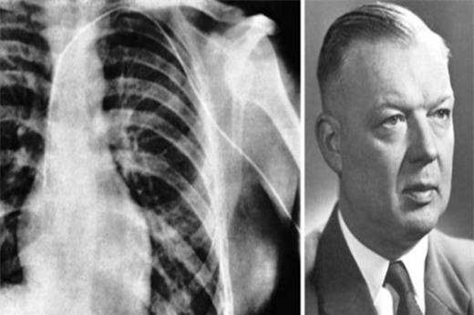 Với thí nghiệm gây thót tim này, bác sĩ&nbsp;Forssmann đã giành&nbsp;một giải Nobel. (Ảnh: Internet)