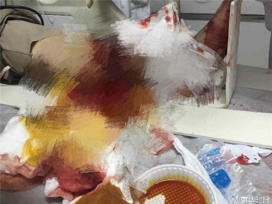 Thang máy đột ngột khởi động nuốt chân người, kéo lê 15 tầng - Ảnh 2.