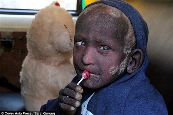 benh-la-khien-cau-be-trong-nhu-tuong