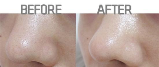 Lột mụn đầu đen