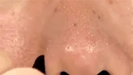 trị mụn đầu đen