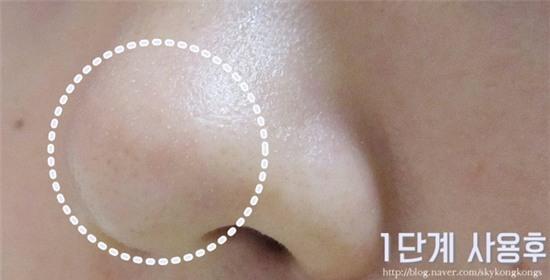 Lột mụn đầu đen