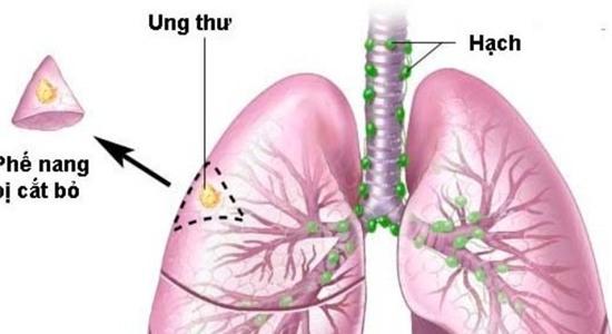 ung thư phổi, tử vong nhanh, di căn, giai đoạn cuối