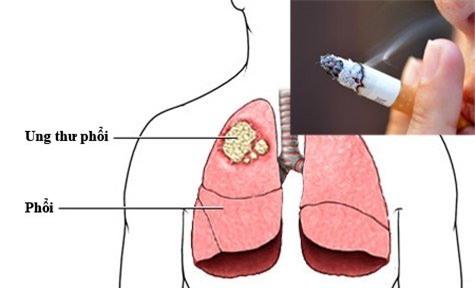 ung thư phổi, tử vong nhanh, di căn, giai đoạn cuối