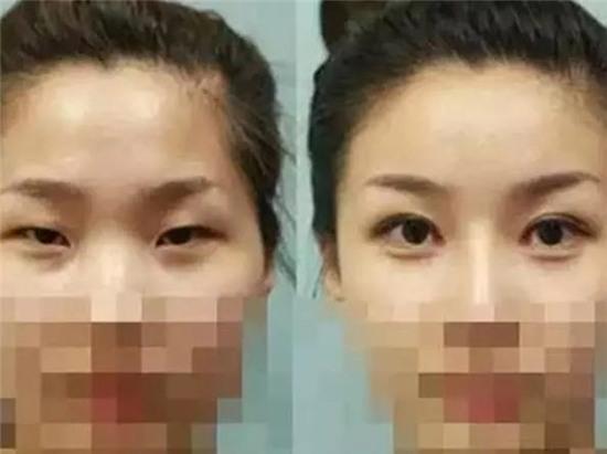 Sau nửa năm đi cắt mí mắt, nữ sinh bỗng phát hiện bị nhiễm HIV - Ảnh 2.