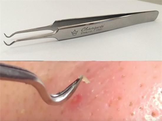 nhíp gắp mụn đầu đen