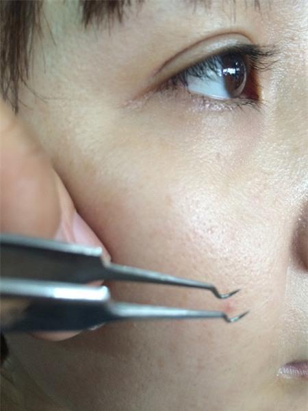 nhíp gắp mụn đầu đen