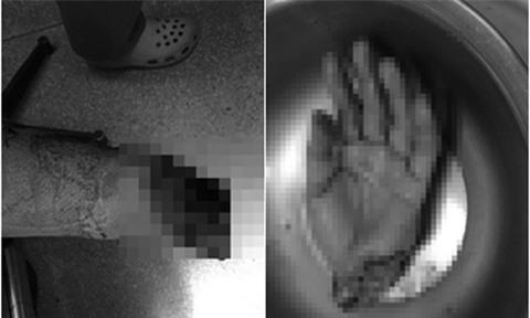 Nam công nhân bị máy cưa gỗ cưa đứt lìa cổ tay trái - Ảnh 1.