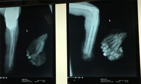 Nam công nhân bị máy cưa gỗ cưa đứt lìa cổ tay trái - Ảnh 2.