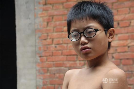 Cậu bé mới 11 tuổi đã phải đeo cặp đít chai dày cộp hơn 2.000 độ cận thị - Ảnh 1.