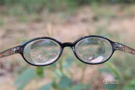 Cậu bé mới 11 tuổi đã phải đeo cặp đít chai dày cộp hơn 2.000 độ cận thị - Ảnh 2.