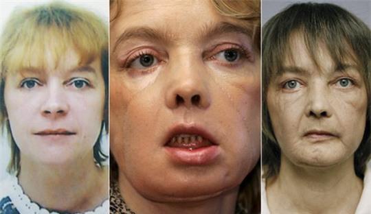 Bà Isabelle Dinoire trước và sau khi được ghép mặt. Ảnh: BBC