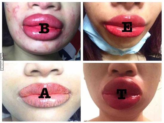 Trào lưu bơm môi căng mọng của chị em và những kết quả... thảm họa không ngờ - Ảnh 1.