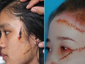 Ba vụ nữ sinh rạch mặt gây xôn xao dư luận