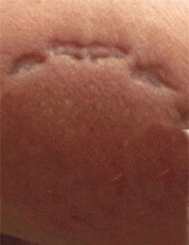 Vết răng trên tay chiến sỹ Nguyễn Mạnh Cường.