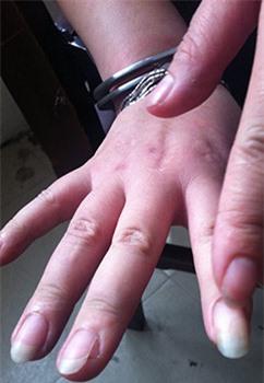 Ngón tay bị cha dượng chém.