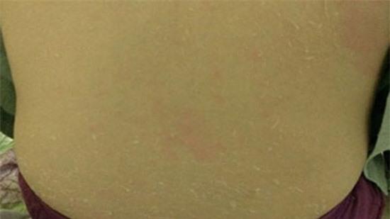 Thiếu nữ Hà Nội bị lột da như rắn vì tắm trắng