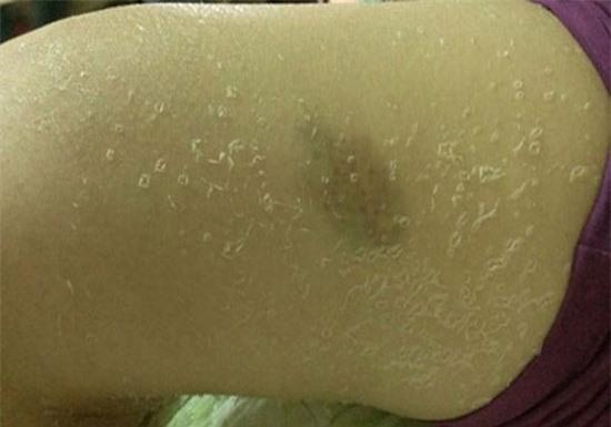 Thiếu nữ Hà Nội bị lột da như rắn vì tắm trắng