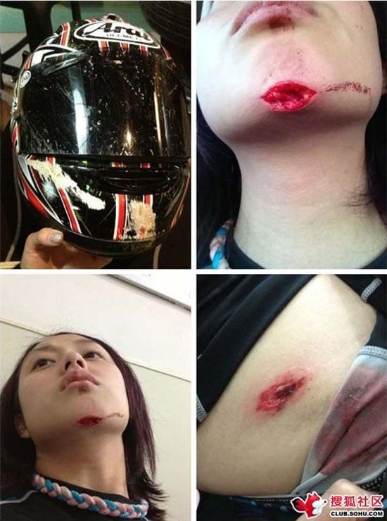 Chấn thương kinh hoàng của nữ tay đua xinh đẹp Đài Loan 1