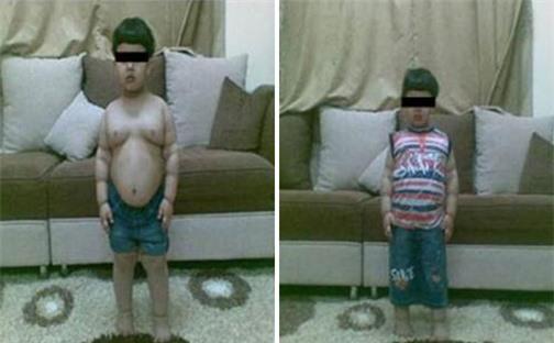 Cậu bé siêu béo được phẫu thuật dạ dày cho gầy bớt 2