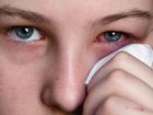 Đau mắt đỏ: Các biện pháp đơn giản trị bệnh tại nhà
