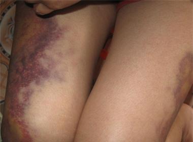 Thương tích trên dùi chị Biên.