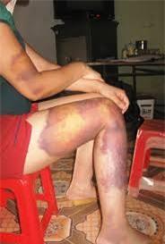 Chuyện tình đẫm nước mắt của người vợ mù bị chồng đánh sau khi ép 'quan hệ' | Bạo hành, Người mù, Vợ chồng, Đánh nhau, Quan hệ tình dục, Ghen tuông