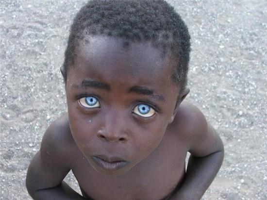 Cậu bé da đen có đôi mắt xanh biếc như đá Sapphire 1