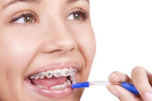 Niềng răng: lợi nhiều, hại cũng không ít 2