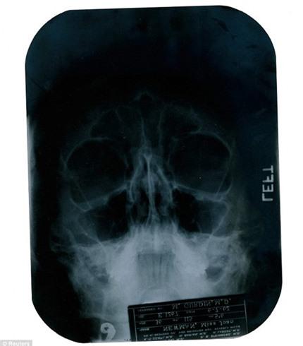 Những bằng chứng về việc Marilyn Monroe đã phẫu thuật thẩm mỹ.