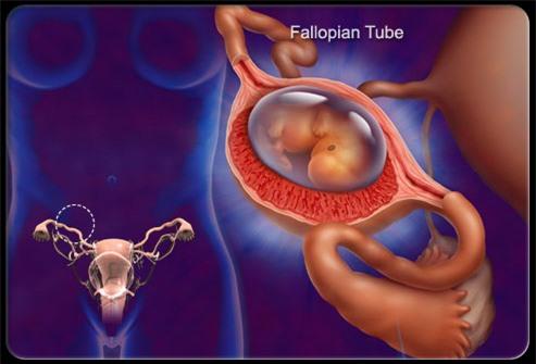 Điểm mặt tất cả nguyên nhân khiến bạn bị đau vùng xương chậu 6