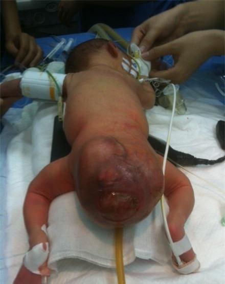  Khối u nặng 0,5kg ở vùng hậu môn của bé gái trước ca phẫu thuật.