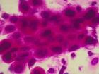 Kiểm tra HPV thay thế cho Pap để phát hiện ung thư cổ tử cung