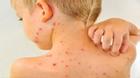 Những bệnh về da phổ biến ở trẻ nhỏ