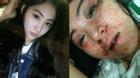 Nữ ca sĩ Trung Quốc bị đánh biến dạng mặt vì không chịu tiếp khách