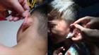 Cô giáo dập ghim vào tai trẻ 4 tuổi