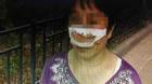 Trung Quốc: Cắn đứt mũi vợ vì không chịu trả lời điện thoại
