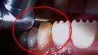 Cận cảnh quy trình thẩm mỹ răng khiến ai xem cũng phải ghê răng