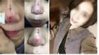 Một cô gái Sài Gòn chia sẻ trải nghiệm khủng khiếp sau khi nâng mũi bằng 