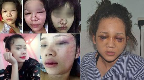 Thảm kịch của những cô gái bị người yêu đánh đập dã man