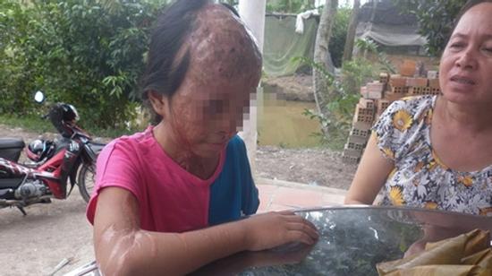 Rớt nước mắt với ước mơ của cô bé bị tạt axit được lên báo Anh