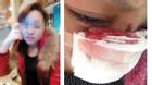 Cô gái bị chồng cắt mũi và bạo hành nhiều lần trong 8 năm chung sống