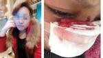 Cô gái bị chồng cắt mũi và bạo hành nhiều lần trong 8 năm chung sống