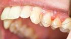 5 bệnh về hàm răng tiết lộ nhiều điều về sức khỏe không thể bỏ qua