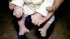 Em bé có tới 31 ngón tay, chân ở Trung Quốc