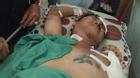 Ca sĩ Việt bị tai nạn mất một cánh tay