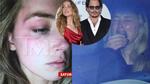 Amber Heard tung ảnh bầm mắt, tố Johnny Depp bạo hành mình
