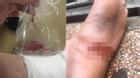 Hà Nội: Thanh niên suýt bị cưa chân vì... cục bông gòn bác sĩ 
